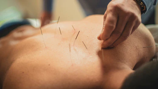 Agopuntura per alleviare i sintomi del ciclo e della sindrome premestruale (PMS): un approccio naturale ed efficace