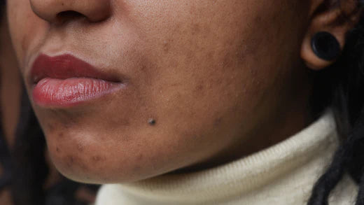 Come riconoscere e curare l'acne ormonale?